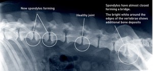 spondylosis