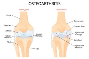 Knee Osteoarthritis Normal Joint Detailed Anatomy Osteoarthritis Arthritis